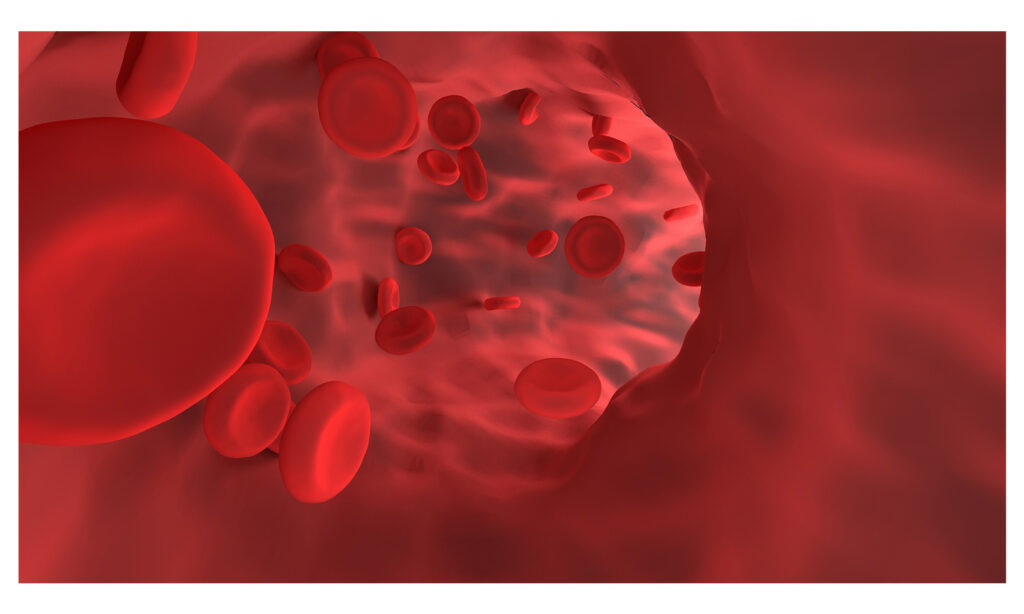 Molecular and clinical presentation of UBA1-mutated myelodysplastic syndromes