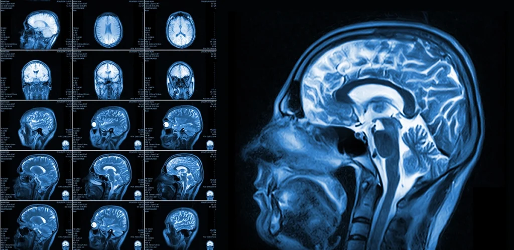 Efficacy of MRI data harmonization in the age of machine learning. A multicenter study across 36 datasets