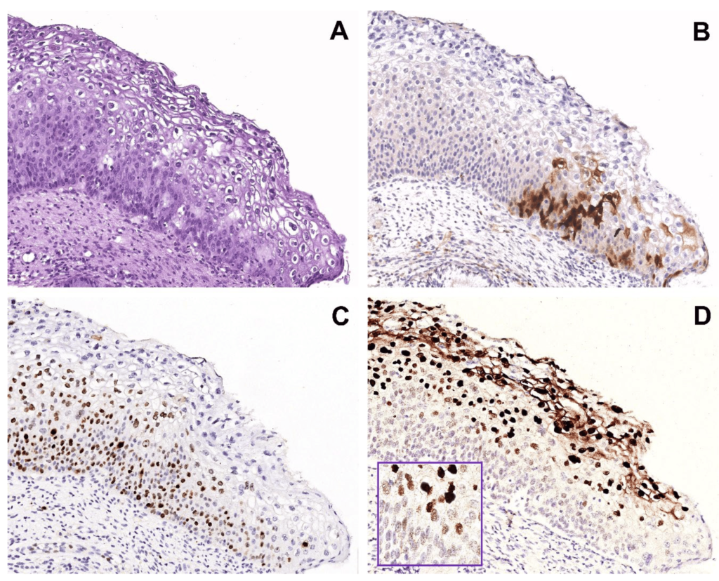 High-Risk HPV CISH Detection in Cervical Biopsies with Weak and/or Focal p16 Immunohistochemical Positivity