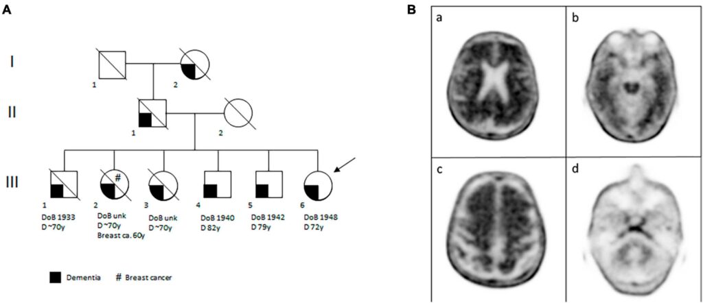 A pathogenic variant in the FLCN gene presenting with pure dementia: is autophagy at the intersection between neurodegeneration and cancer?